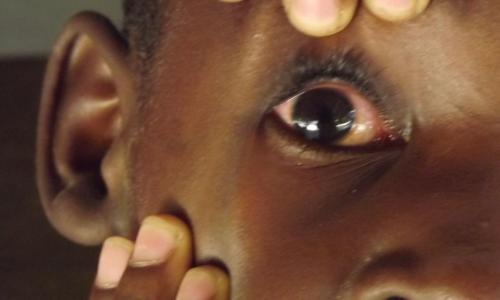 Augeninfektion - August 2015 - Steven